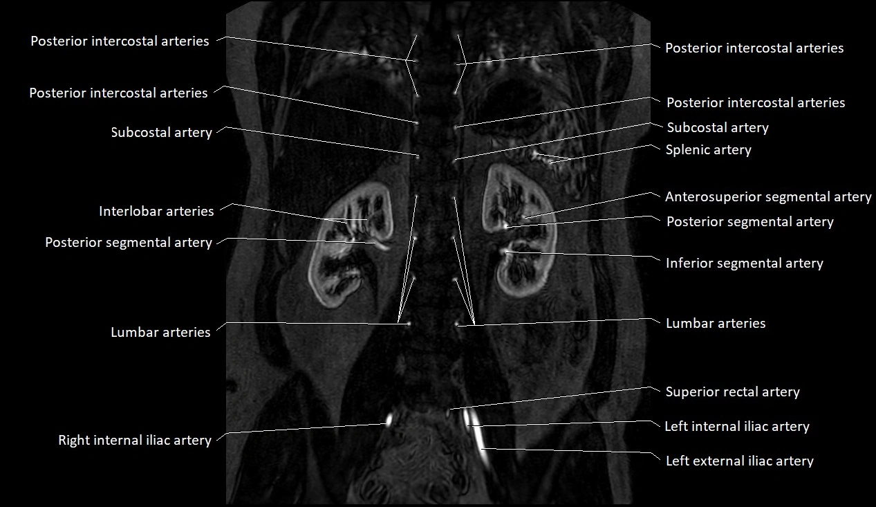 MRA Abdomen coronal anatomy image 34.webp